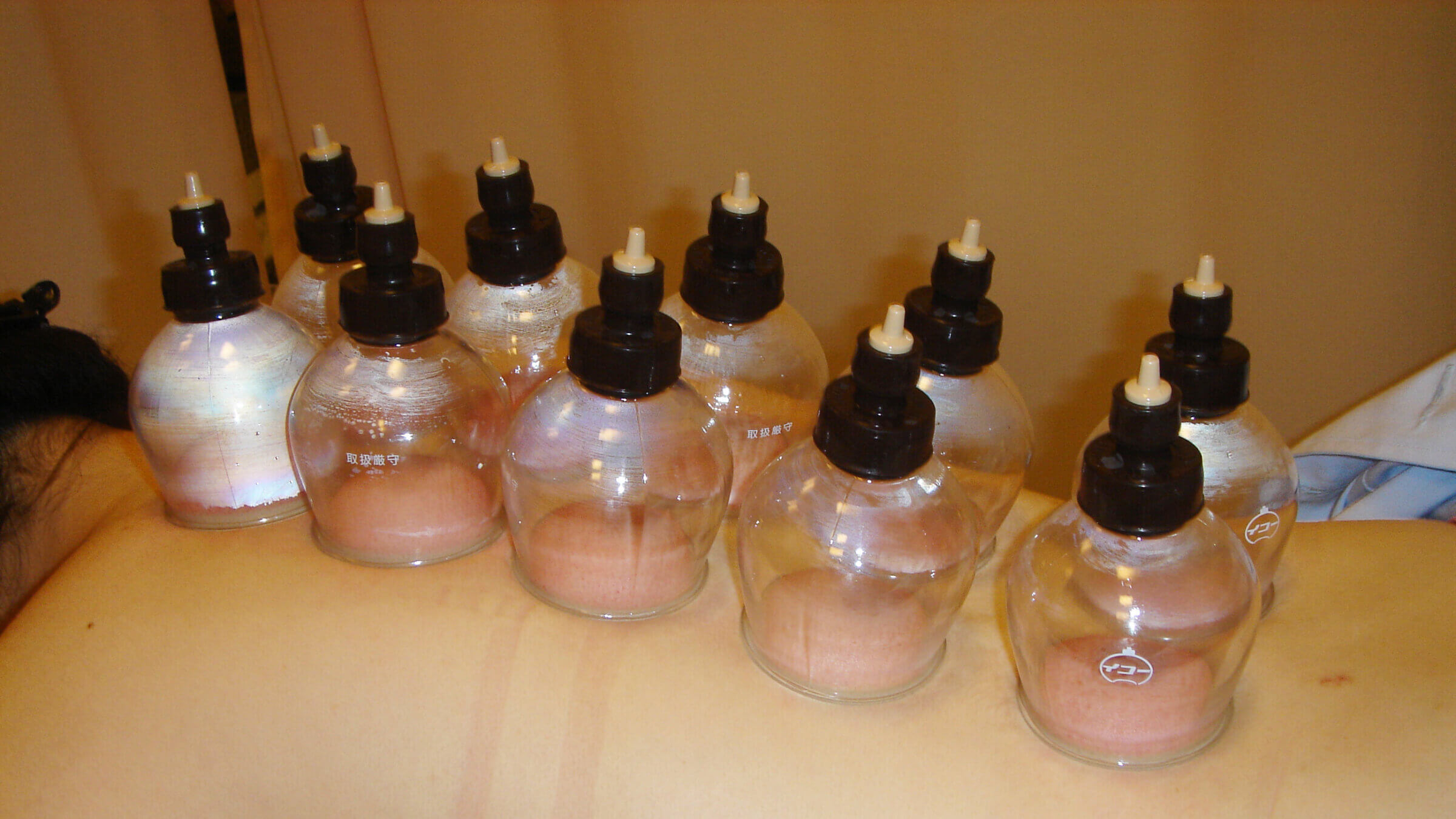 Cupping & Shiatsu